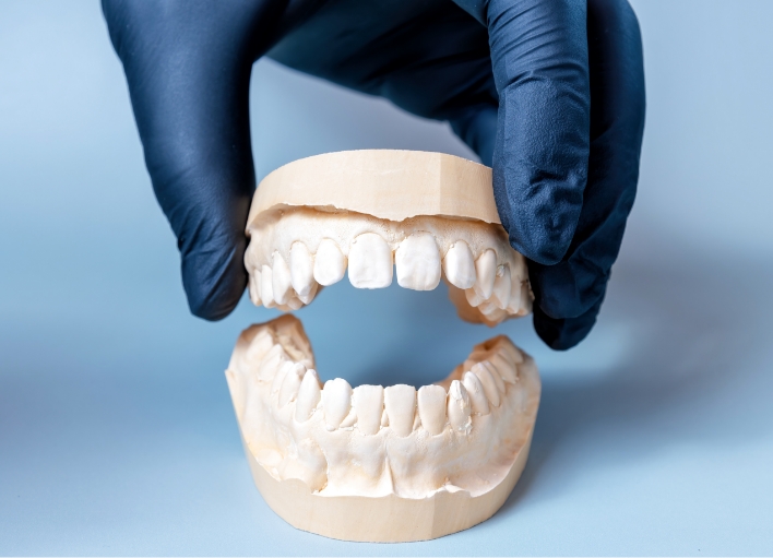 インプラント治療