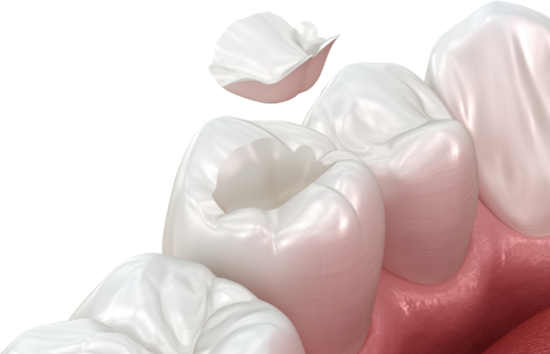 ジルコニア(白い色)