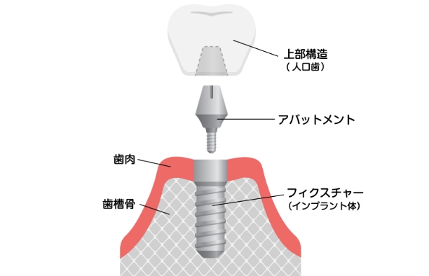 インプラント手術＋上部構造