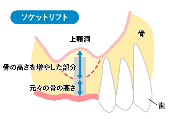 ソケットリフト