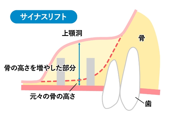 サイナスリフト(片顎)